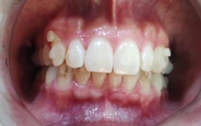 4 meses de tratamiento