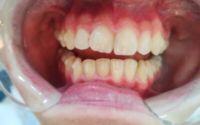 4 meses de tratamiento