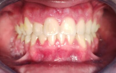 7 meses de tratamiento
