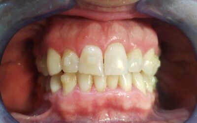 6 meses de tratamiento